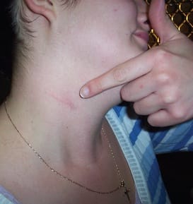 Arpi Leannen kaulassa osoittaa mistä väärässä paikassa oleva, ihmiselle kuuluva rusto (ei kalanrusto) poistettiin.